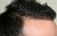 Hair Transplant Before and After Photos image4